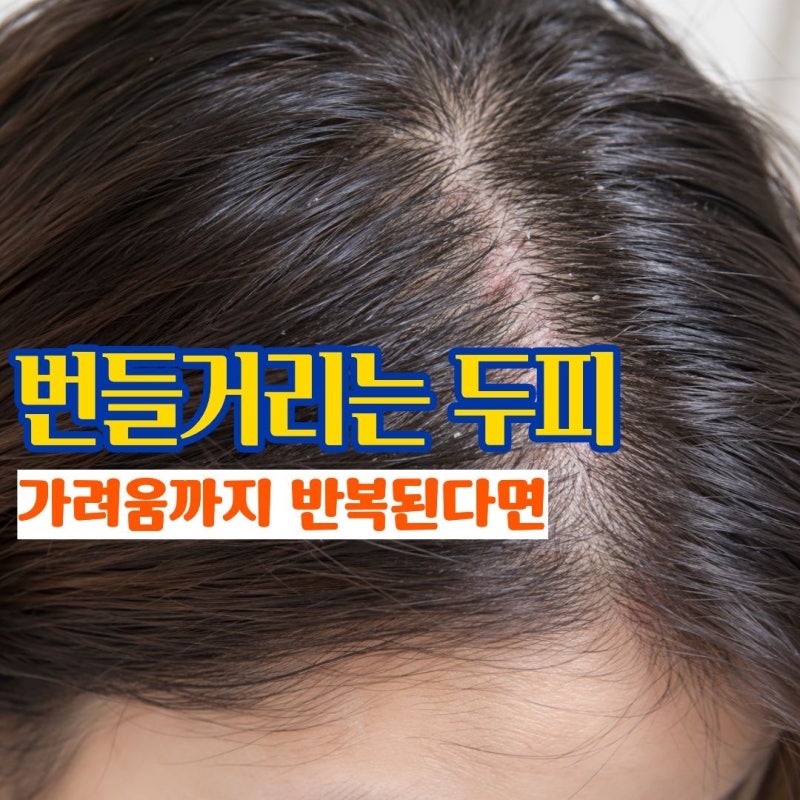 "머리를 감아도 두피가 금세 기름지고 가렵다면" 지루성두피염원인에서 함께 나타나는 변화