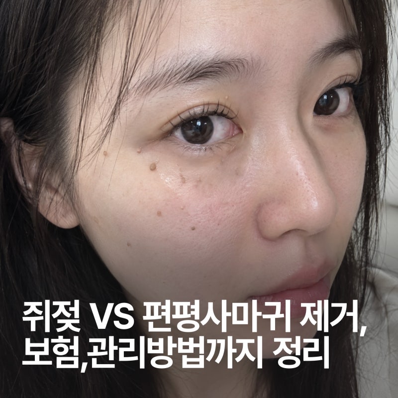 쥐젖 vs 편평사마귀 구분부터 얼굴 쥐젖 제거, 보험, 관리방법까지 정리