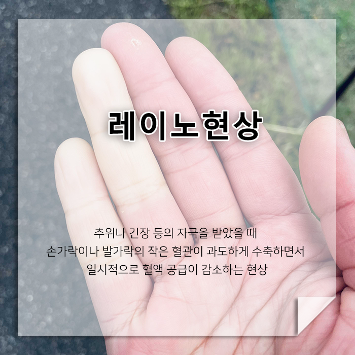 손가락이 갑자기 하얗게 변하고 차가워진다면? 레이노현상