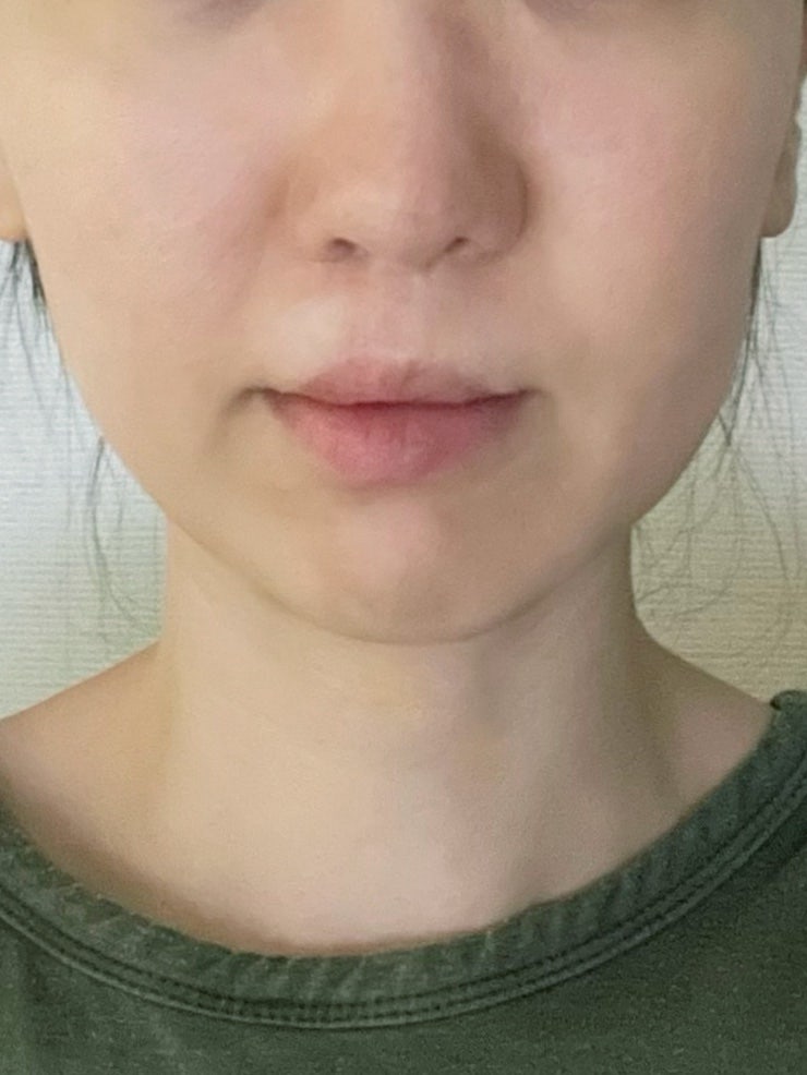 사각턱보톡스 침샘보톡스 효과, 귀밑 턱밑까지 받아본 솔직후기