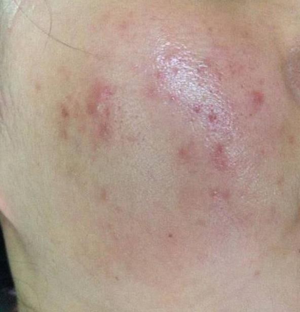 접촉성 피부염 연고 리도맥스, 비판텐, 프로토픽 다 써보고 결정한 관리법