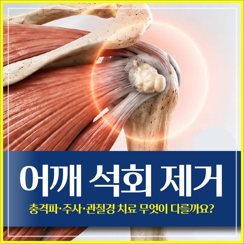 어깨 석회 제거, 충격파·주사·관절경 치료 무엇이 다를까요?