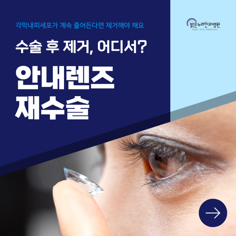 대전안내렌즈삽입술 LCL 제거 수술 고려한다면