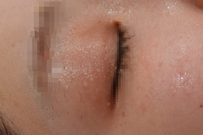 대전편평사마귀) 눈가 편평사마귀, 어떻게 제거할 수 있을까? 눈 편평사마귀 제거 케이스 1례