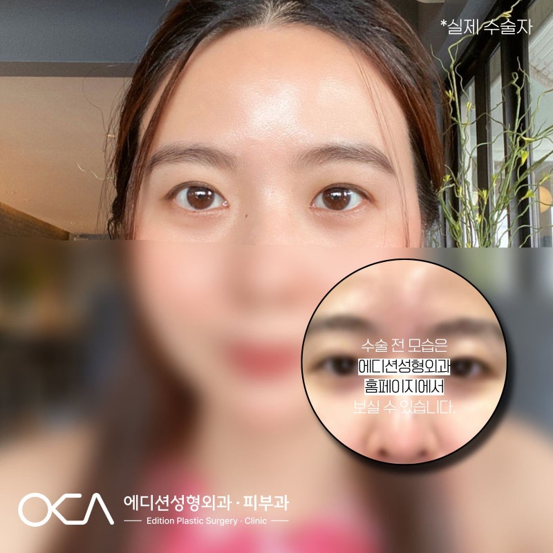 쌍꺼풀재수술잘하는병원 이라면 괜찮을까? — 실패 원인별 수술법·비용·후기사례까지 정리....