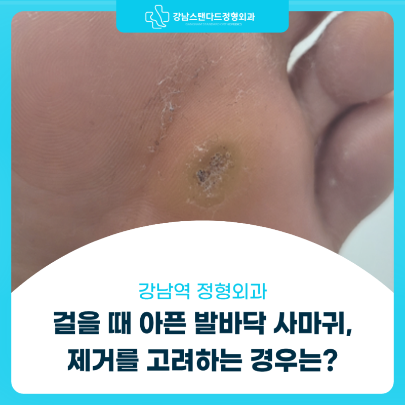 강남역 정형외과, 걸을 때 아픈 발바닥 사마귀, 제거를 고려하는 경우는?
