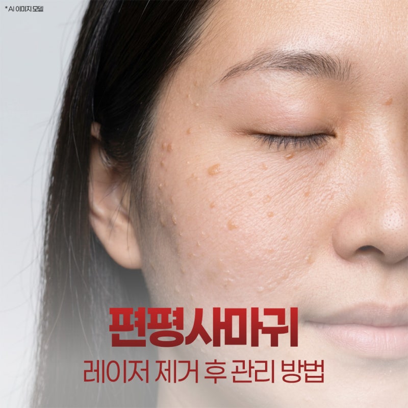 수영역편평사마귀 레이저 제거 후 재발할 수 있나요?