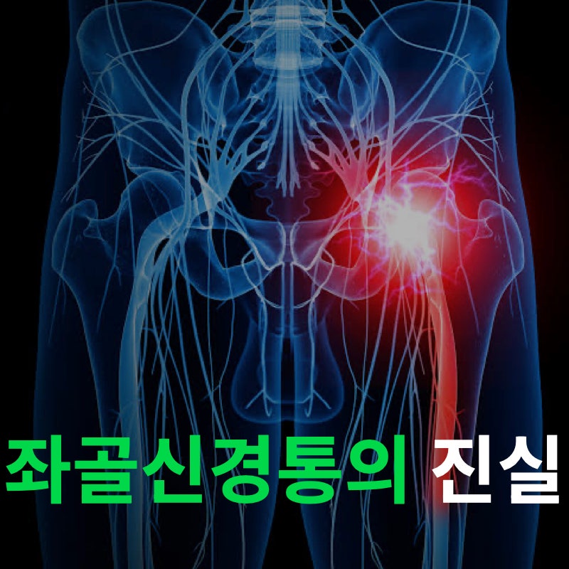 좌골신경통의 진실