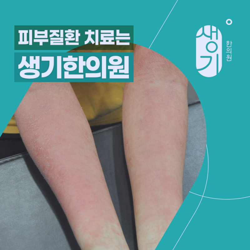 한랭두드러기 치료 찬바람 맞을 때 마다 피부가 올라온다면