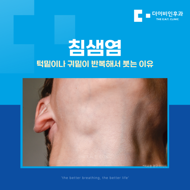 침샘염, 턱밑이나 귀밑이 반복해서 붓는 이유