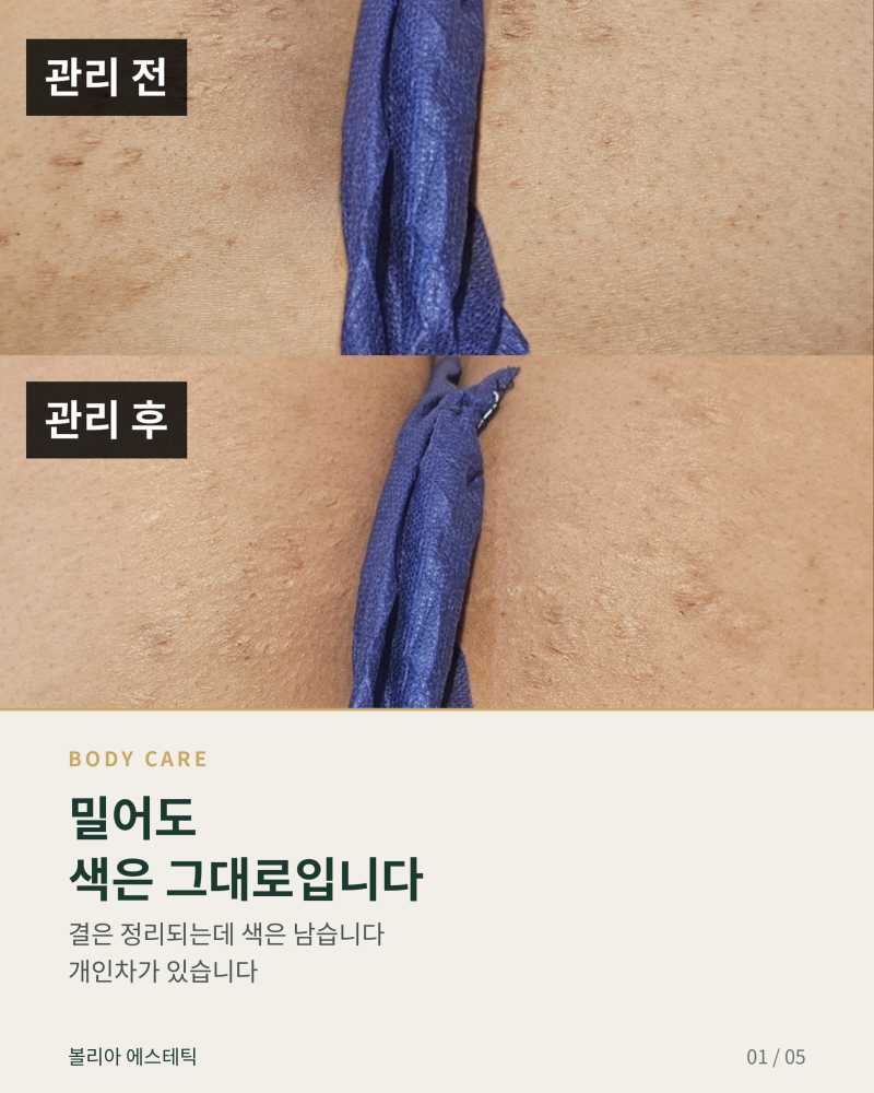 눌리는 자리에 색이 남습니다 — 엉덩이 · 겨드랑이 · 등