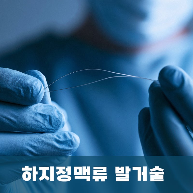 하지정맥류 혈관이 너무 굵어 시술이 어렵다면 발거술(고위 결찰술)을 해야 하나요? - 부산 ....