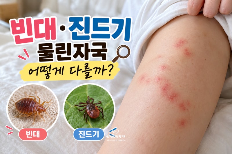빈대 물린 자국 진드기 물린 자국 차이, 빨간 점 3개 나란히 생겼다면?