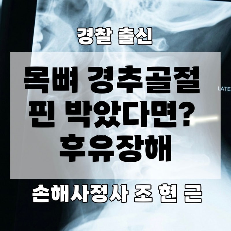 교통사고 목뼈 경추골절 핀 박았다면? 후유장해 30%와 비수술 기형장해 인정 기준