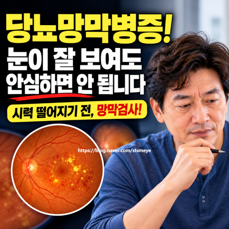 송탄안과 당뇨망막병증, 눈이 잘 보여도 위험할까요? 초기증상부터 망막검사·치료까지