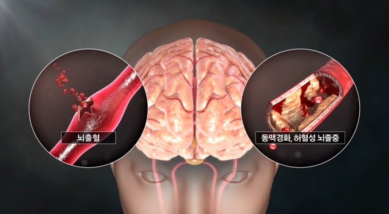 [EBS 명의] 20~30대도 안심 못 하는 뇌졸중, 골든타임이 24시간까지 늘어났다?