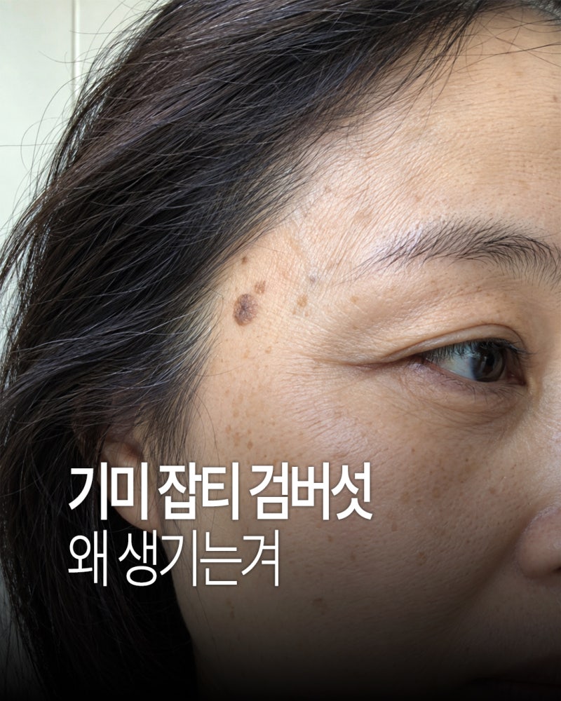 기미 주근깨 차이와 원인, 없애는법 있나...? (+검버섯)