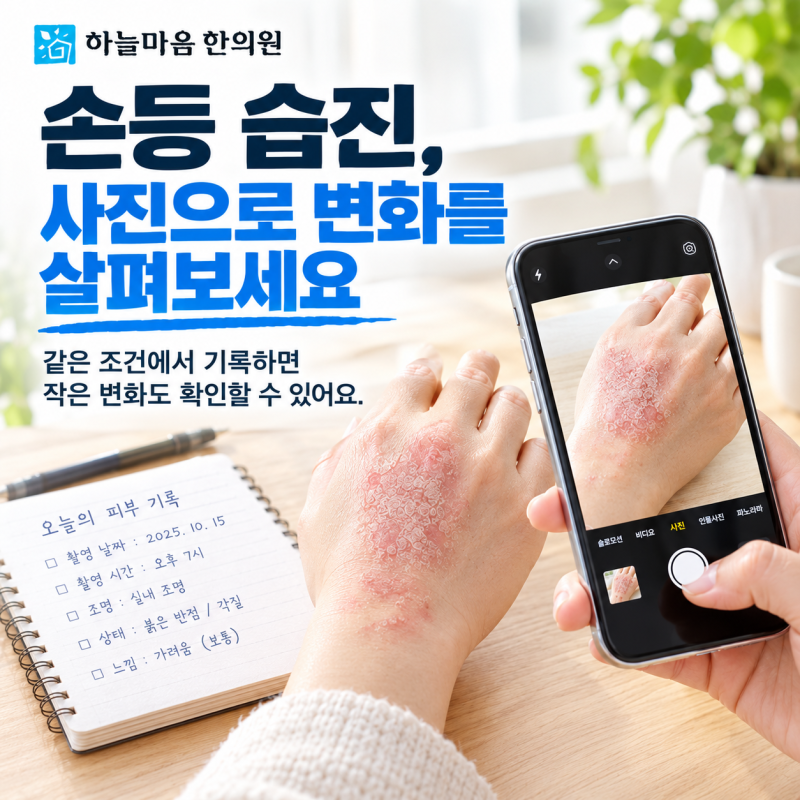 손등 습진, 사진 비교로 변화를 확인하고 바쁜 일상 속 관리 순서를 알아봅니다