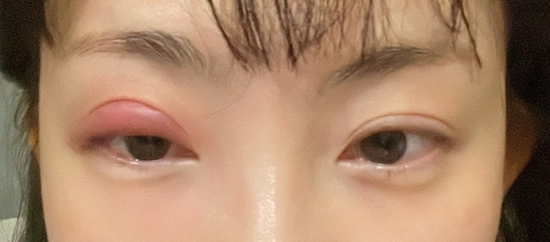 눈 다래끼 초기증상부터 경과 치료 째기 수술 흉터주사 후기