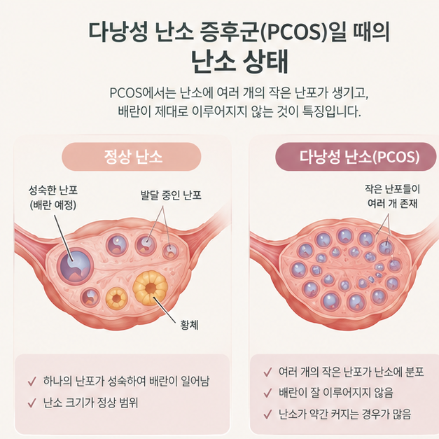 다낭성 난소 증후군 증상, 도움되는 영양제 이노시톨!