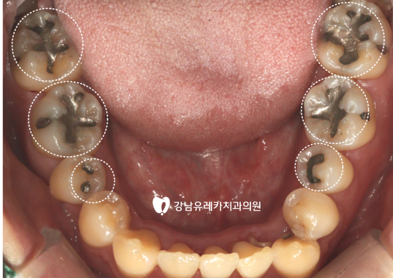 [신논현치과] 오래된 아말감, 꼭 교체해야 할까요? 교체가 필요한 경우와 필요 없는 경우