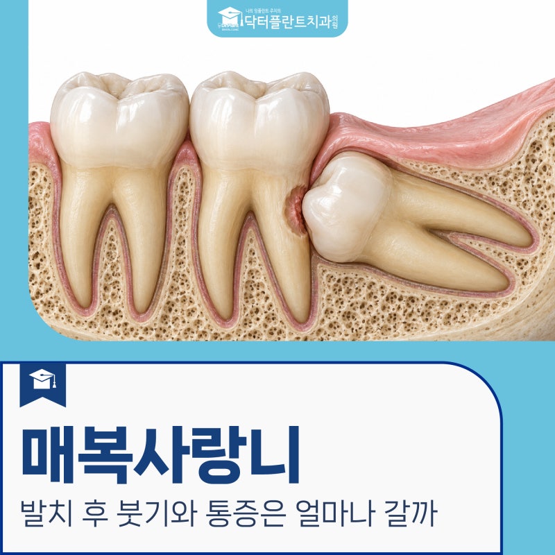 상계동 치과 매복사랑니, 발치 후 붓기와 통증은 얼마나 갈까요?