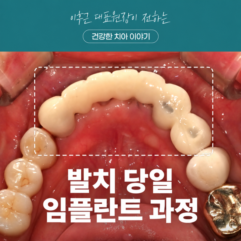 앞니 임플란트와 임시치아를 고려할 때 확인 기준