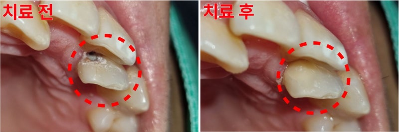 앞니 치아 인접면 충치치료, 깊은 충치도 신경치료 없이 치료한 사례｜불규칙한 치열과 충치....