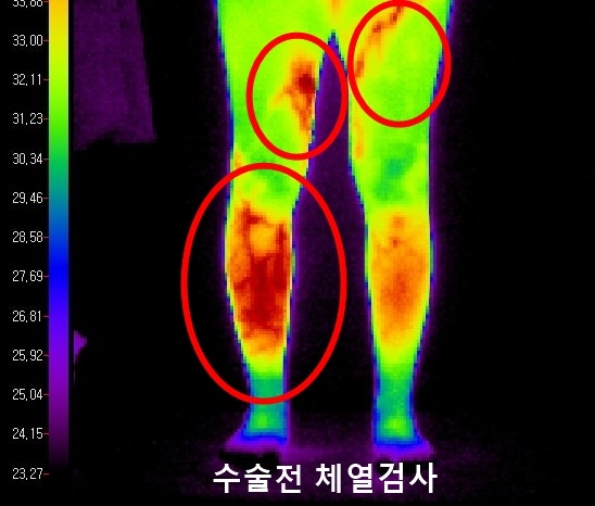 의정부 하지정맥류 "하지정맥류가 재발했나봐요. 다리가 저리고 경련이 생겨요" 연세고든....