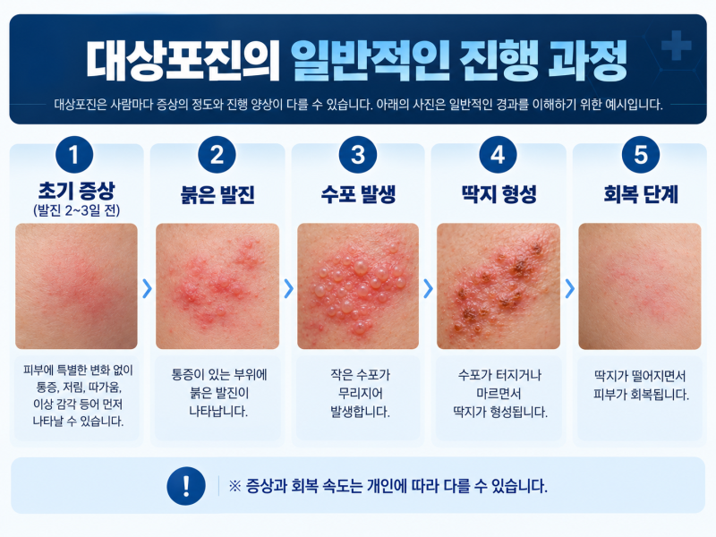 대상포진 초기증상은 어떻게 시작될까? 감기몸살·근육통으로 착각하기 쉬운 전조증상