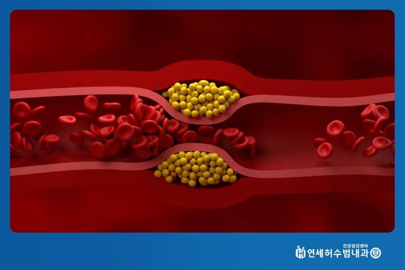 고지혈증 증상 손발저림 어지러움 눈밑떨림 나타나나요?