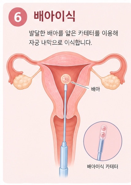 시험관 배아이식 후 배가 콕콕 아픈 이유｜착상 과정에서 나타날 수 있는 증상일까?