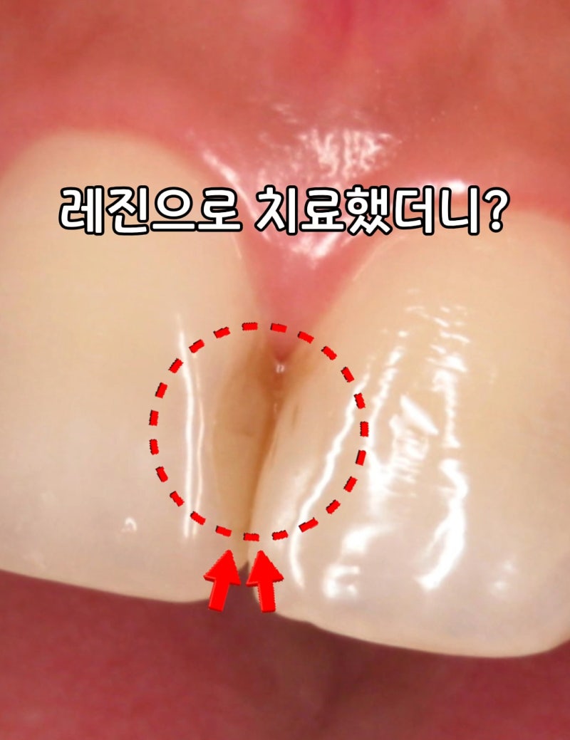 앞니 충치, 레진 치료 5년 후 이렇게 변했어요 ㅠ(2차 충치)