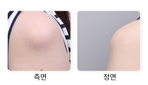 대구지방종제거병원, 어깨 지방종은 수술 흉터까지 살펴봅니다