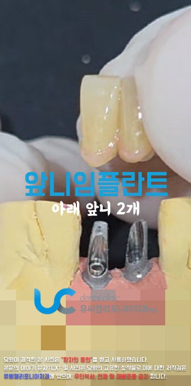 앞니통증 앞니 흔들림 임플란트 or 브릿지 비용 무엇을 선택해야 할까?