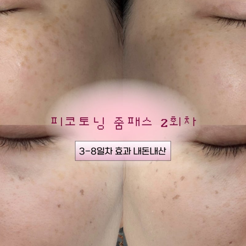 대구 피코슈어토닝 피코줌패스 2회 효과 3-8일차 딱지 경과 후기 주근깨 기미 레이저 잡티제....