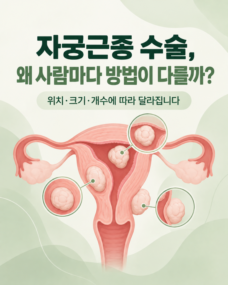 자궁근종 수술 방법 종류와 차이, 위치·크기에 따라 달라지는 이유