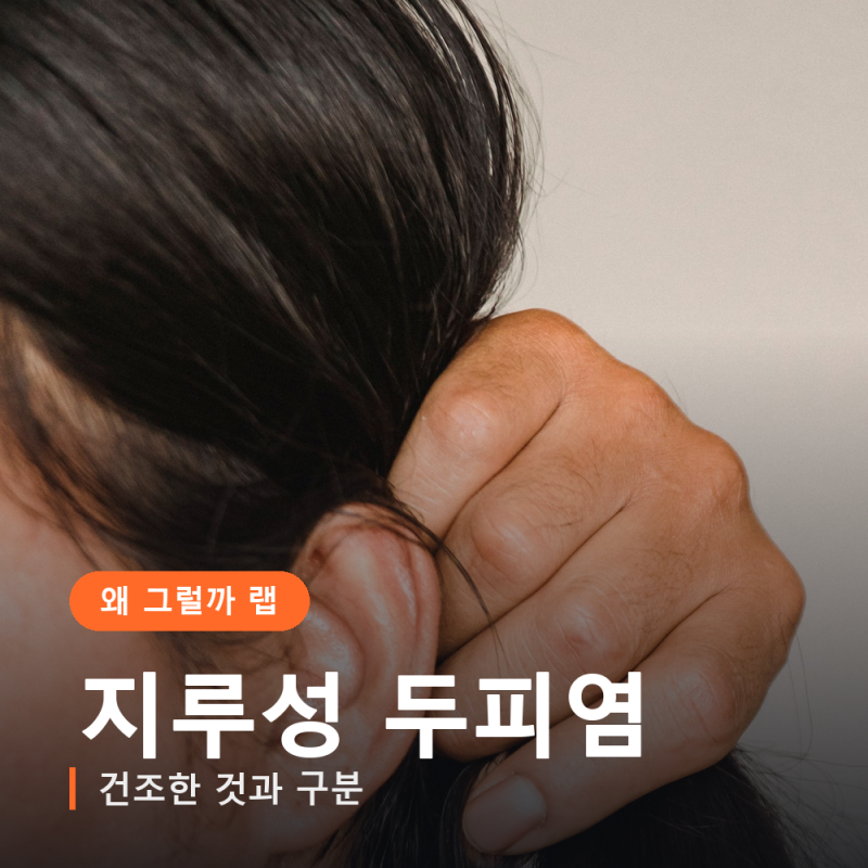 지루성 두피염 증상, 그냥 건조한 것과 구분하는 법