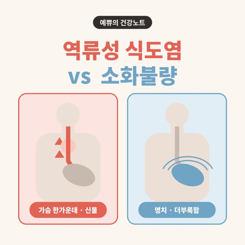 [예쀼의 건강노트] 역류성 식도염 vs 소화불량 구분법, 아픈 위치부터 보세요