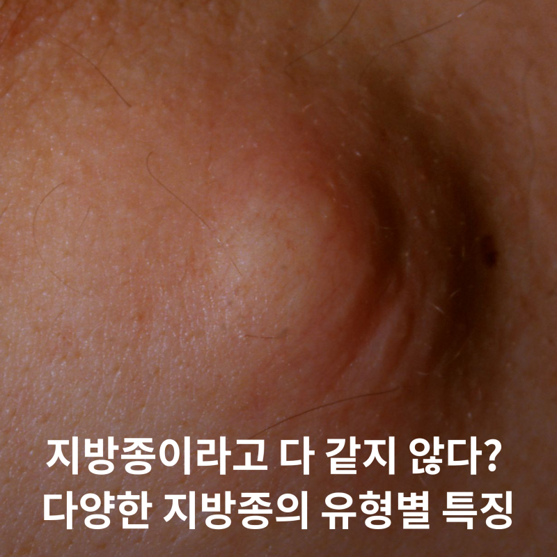 지방종이라고 다 같지 않다? 다양한 지방종의 유형별 특징