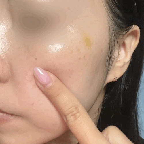대구수성구피부과 스킨보톡스 1주일차 피부 변화는?
