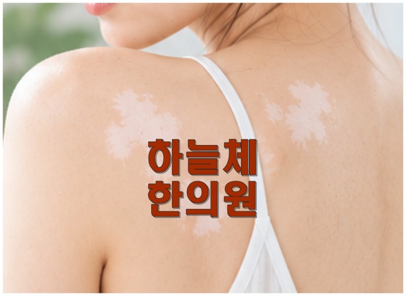 대전백반증치료한의원, 하얀 피부는 다시 색이 돌아올 수 있을까요?