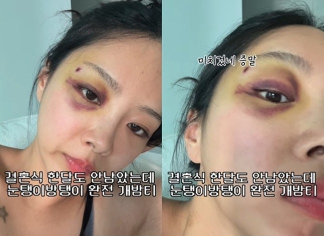 바람 잘 날 없는 10기 옥순 유현철과 결혼 앞두고 눈에 피멍이 웬 말?