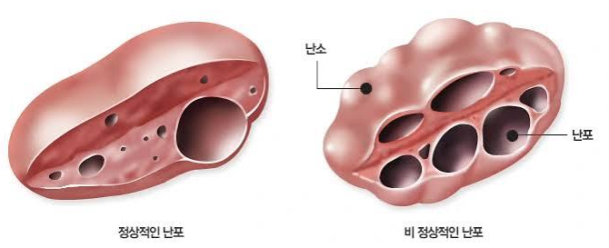 다낭성난소증후군 원인부터 증상, 검사, 관리까지｜생리불순 20-30대라면 꼭 확인!