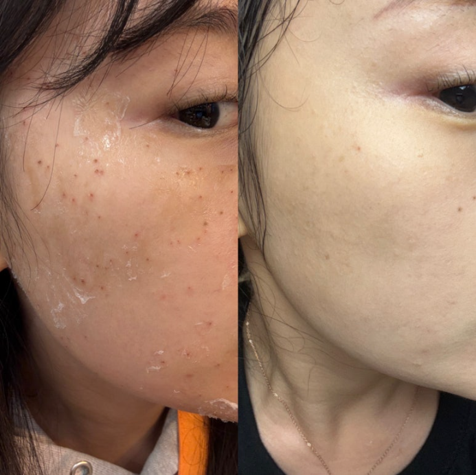 인천 부평 편평사마귀 무제한 제거 성지 내돈내산 (비용/통증/경과)