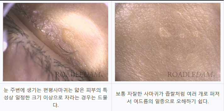 얼굴·목 편평사마귀 원인, 피부 면역과 건강을 함께 봐야 하는 이유