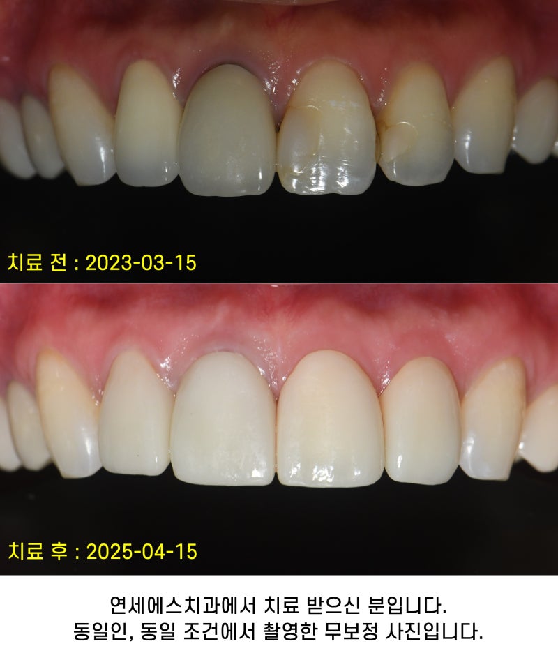 앞니 신경치료 후 크라운 변색 레진 착색, 지르코니아 크라운