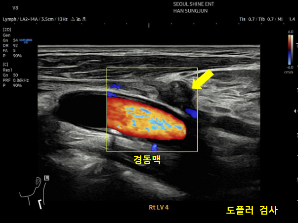 구강암 림프절 전이, case