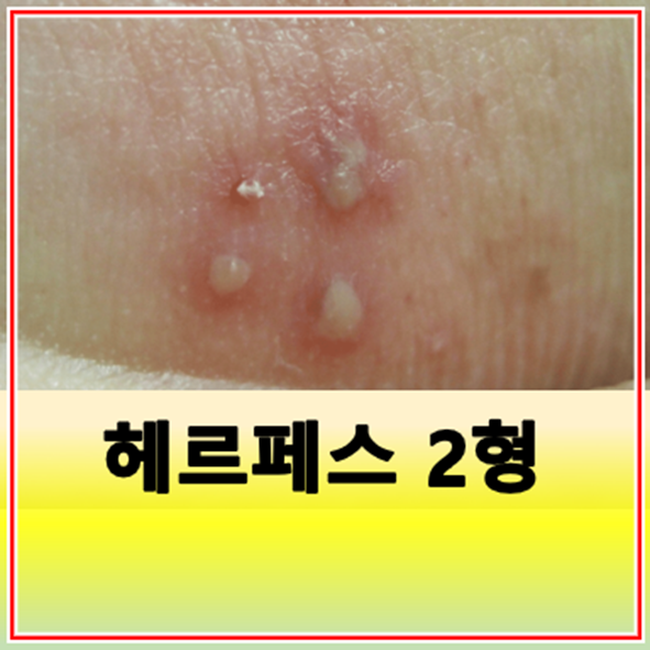 헤르페스 2형 원인 전염 증상 완치