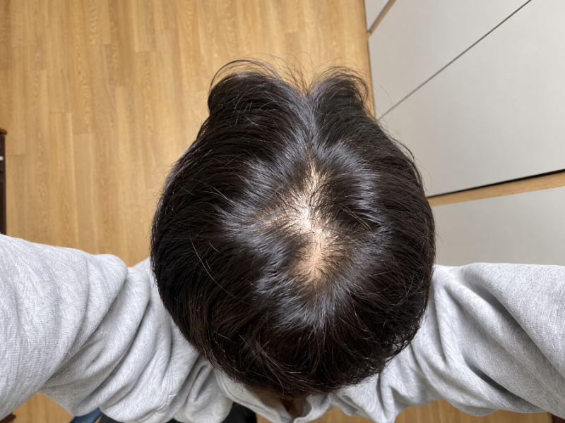 대전탈모치료 장효식내과 처방료, 약값까지 내돈내산 찐후기